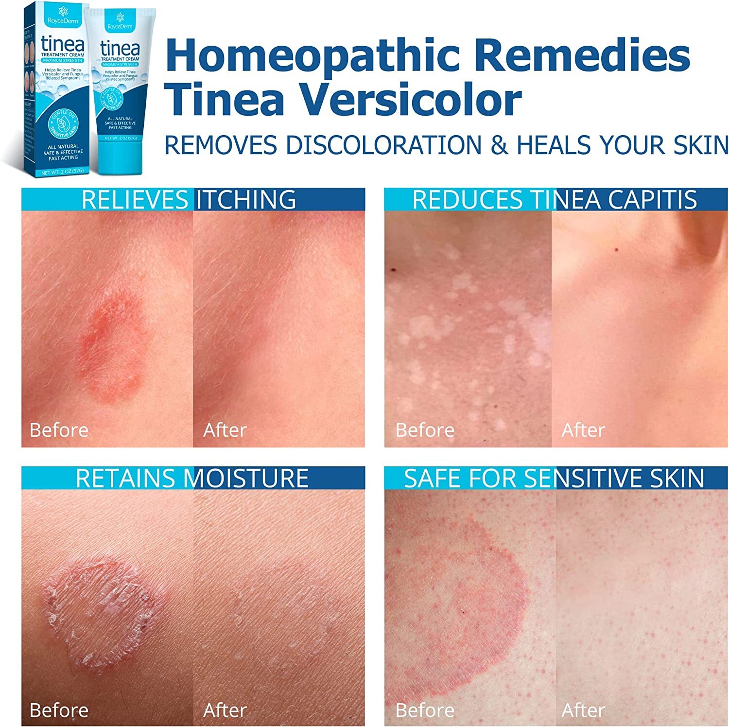 Roycederm Tinea Versicolor & Pedis Treatment, Antifungal Cream 2 Oz Exp 08/2024