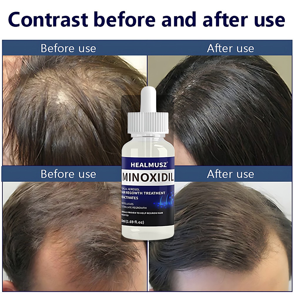 Hair Regrowth Liquid- 5% Minoxidil Topical Solution for Thicker Hair Grow 50ml*2