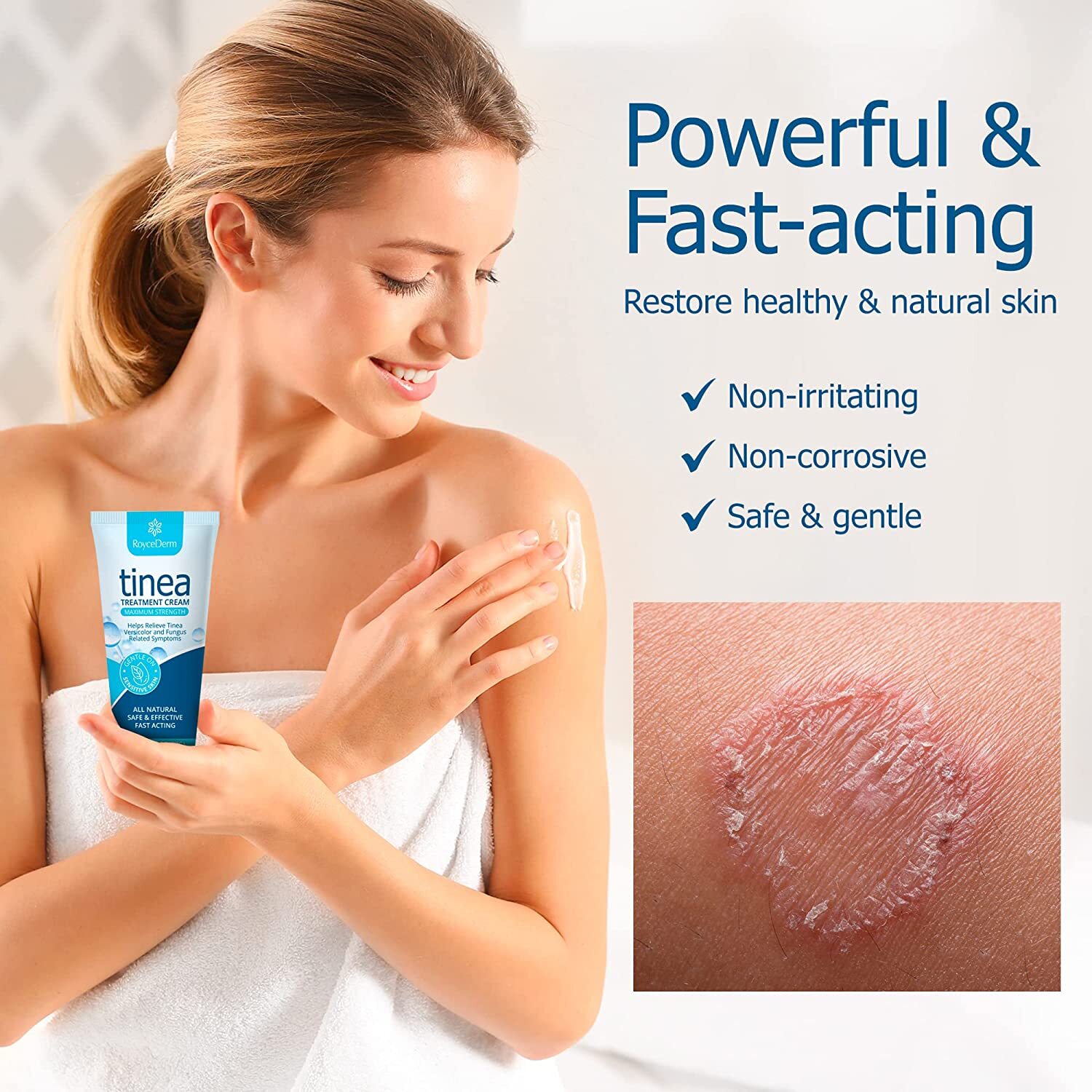 Roycederm Tinea Versicolor & Pedis Treatment, Antifungal Cream 2 Oz Exp 08/2024