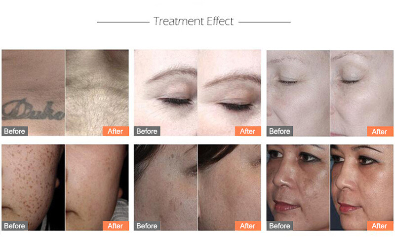3-in-1 Nd:YAG Pico Laser Eyebrow Tattoo Removal Machine 532 1064 1320nm Device