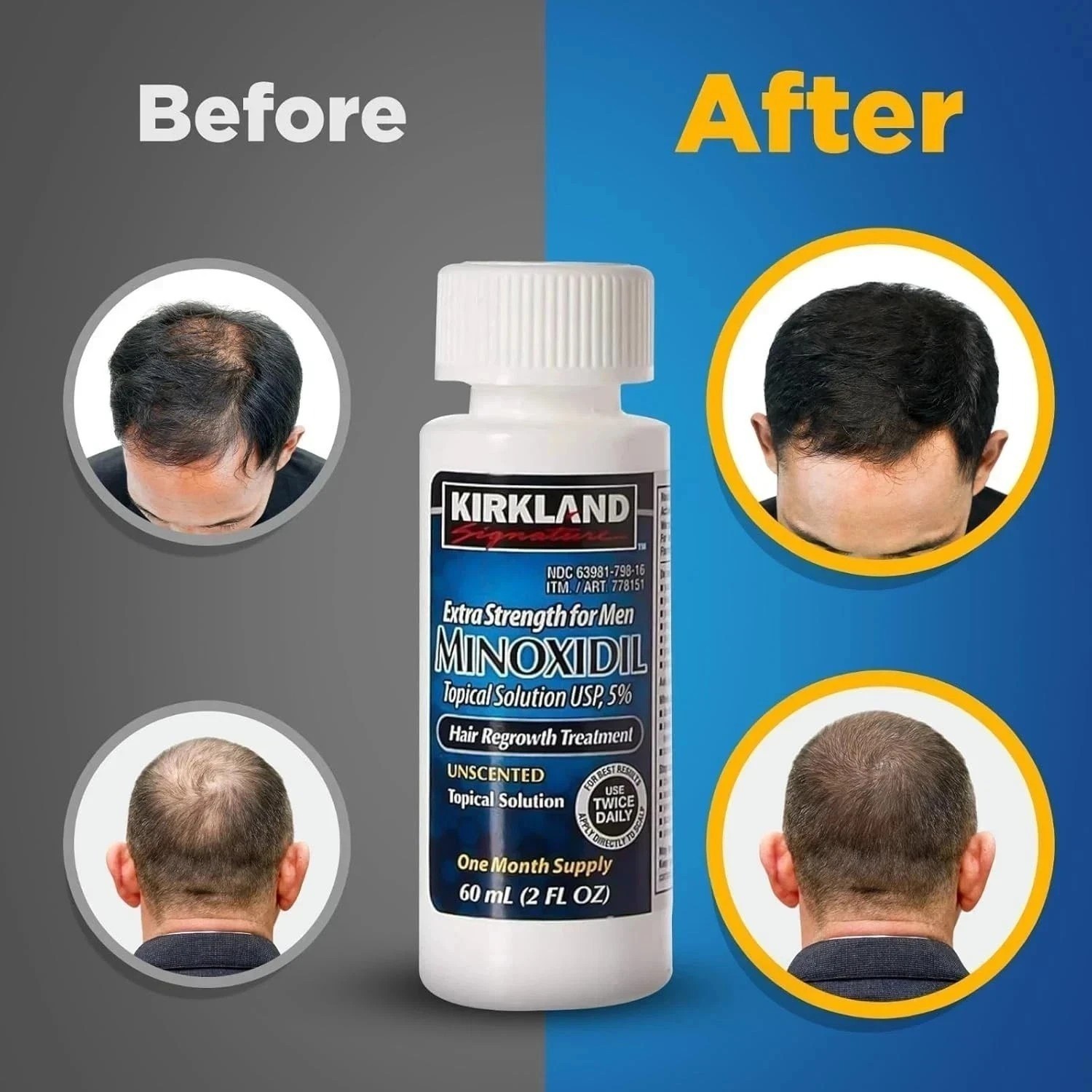 Kirkland Minoxidil 5% Extra Strength Men 6 Month Supply Hair Regrowth NEW USA