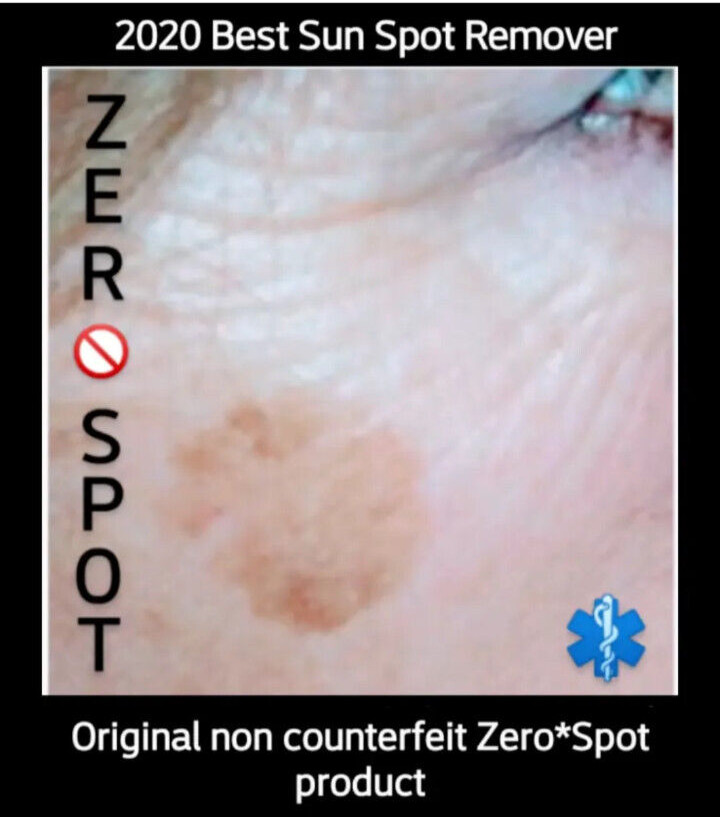 Sun Spot, Age Spot, Brown Spot, Dark Spot Corrector Treatment Remover: No Scam💙
