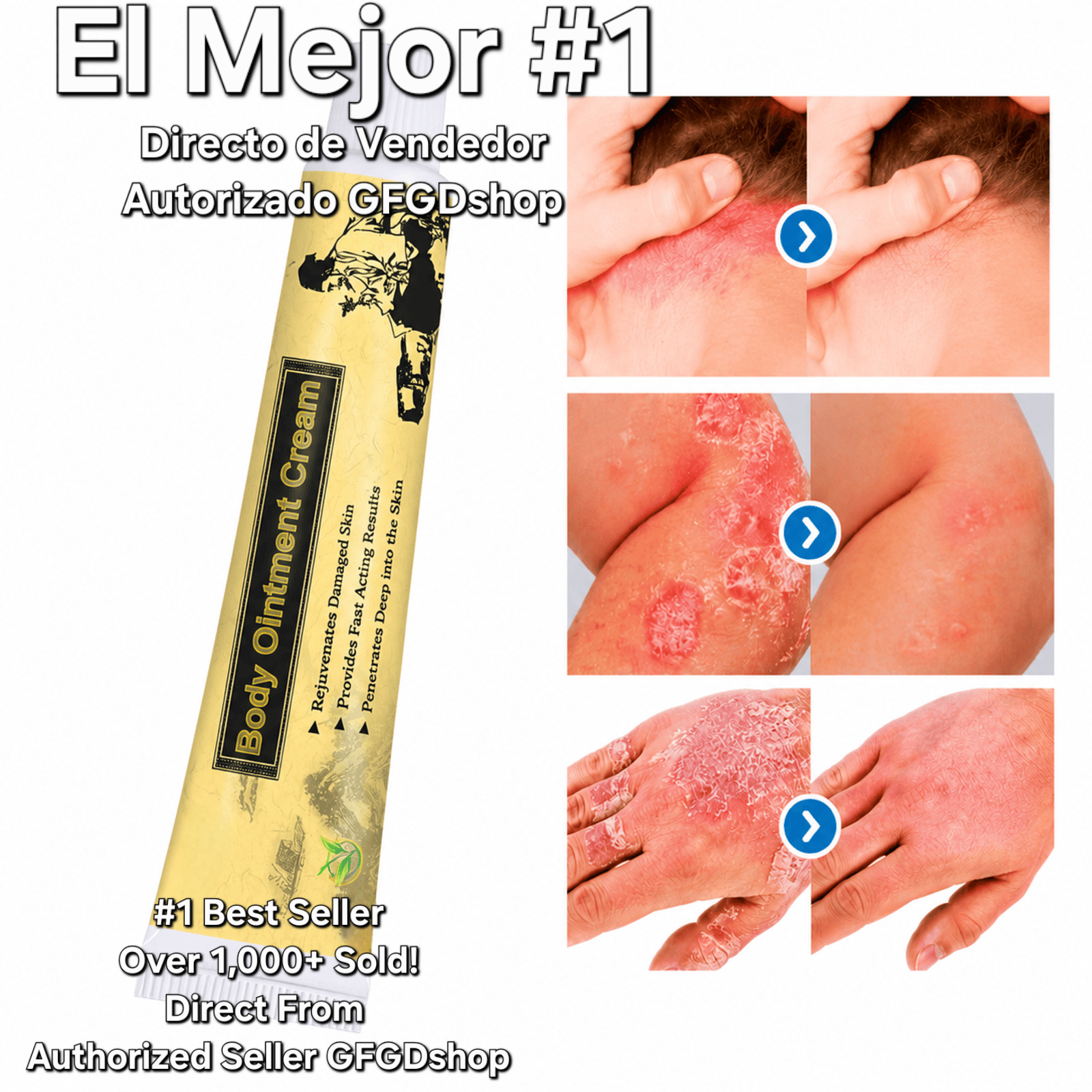 Crema Para Dermatitis Eczema Psoriasis Para Comezon Picazon Ronchas En La Piel