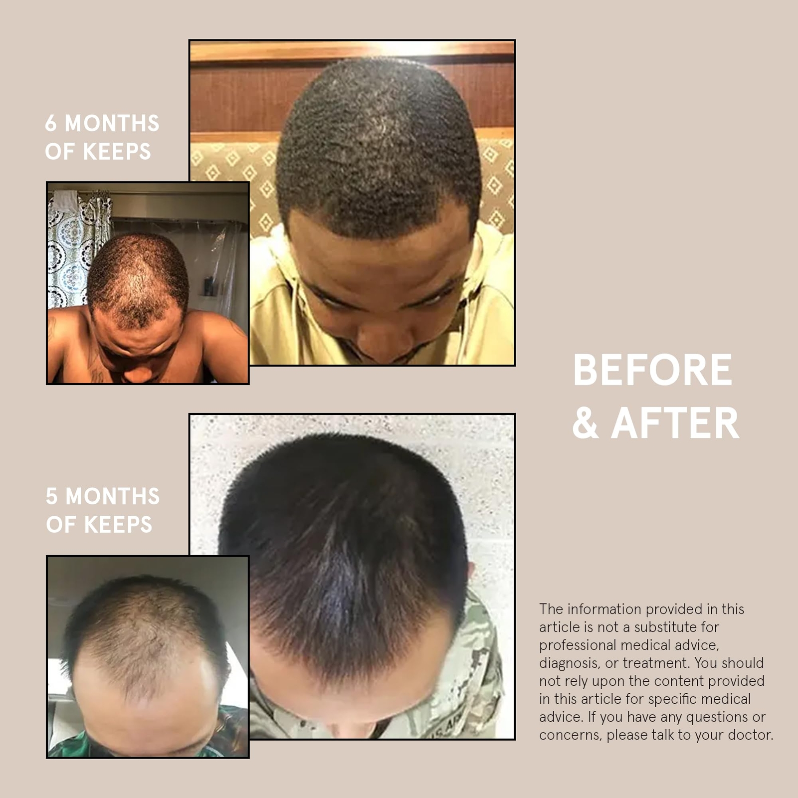 Keeps Extra Strength Minoxidil for Men Topical Hair Growth Serum 5% Solution