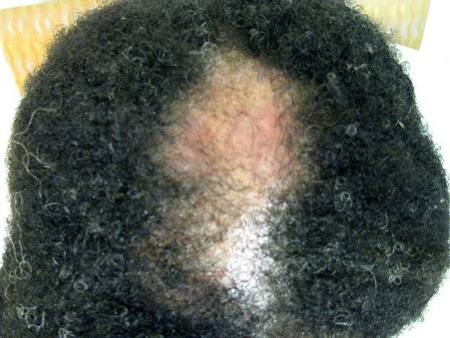 anti inflammation capsules – DHT BLOCKER HAIR FORMULA – zinc hair loss 1BOTTLE