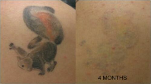 Permanent Tattoo Removal Cream